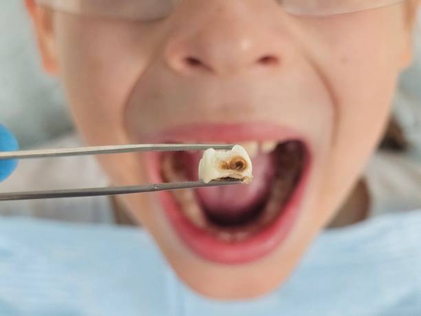 Best Emergency Tooth Extraction in Samoset, FL